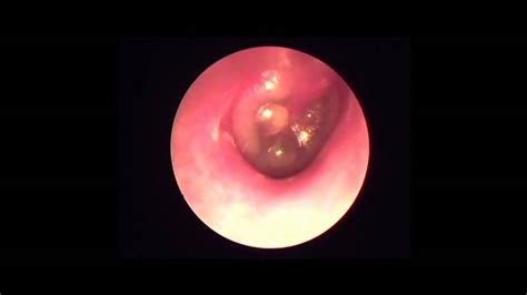 Ear Pain At Night Common Cold Causes Aom Youtube
