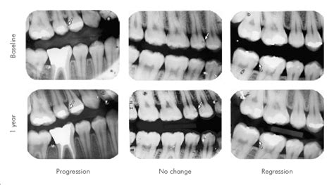 Representative Radiographs Of Caries Lesions That Showed Progression