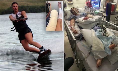 Physiotherapist Has Leg Amputated After 17 Surgeries To Try And Save Limb Following A Car Crash