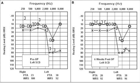 How to read an audiogram and how to understand your hearing test results.what do they mean? A: Preoperative audiogram shows the left-sided low ...