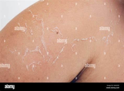 Woman Sunburn Red Skin Hi Res Stock Photography And Images Alamy