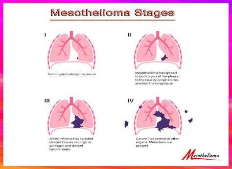 Mesothelioma Stages Prognosis And Survival Rates