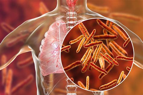 Tuberculosis Of The Bone Can Affect Which Of The Following Cloudshareinfo