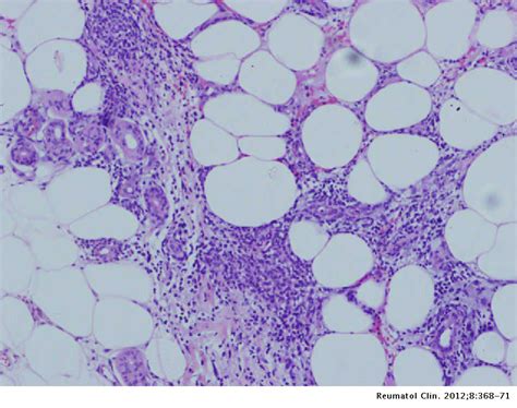 Facticial Panniculitis And Löfgrens Syndrome A Case Reumatología