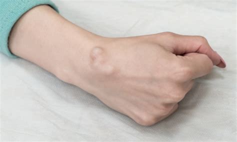 Ganglion Cysts Treatment Remedy Space