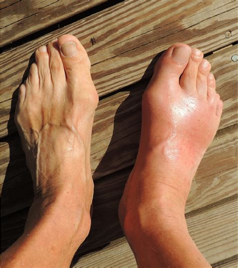 Gout Treatment Options Eugene Foot And Ankle