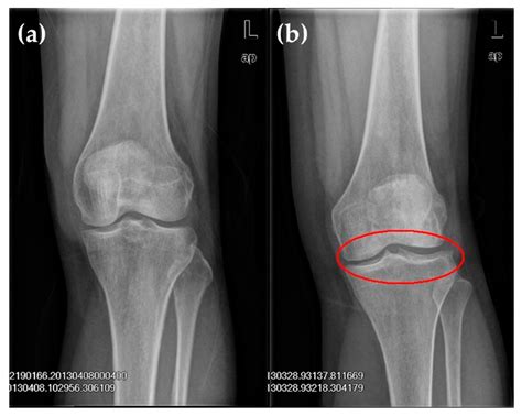 Xray Knee Osteoarthritis