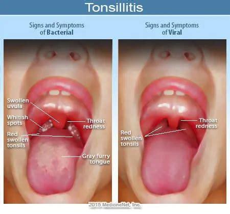 Tonsillitis Treatment Causes Symptoms Pictures Okkii Com