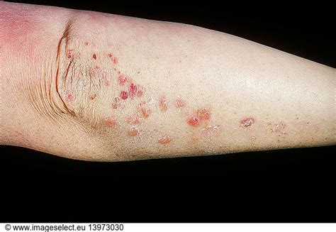 Dermatitis Herpetiformis Dermatitis Herpetiformisabnormalabnormality
