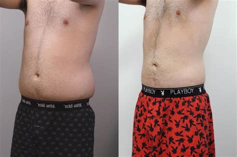 Liposuction In New York City Dr Sterry