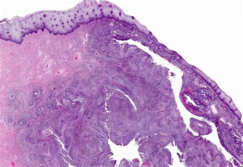 Pathology Outlines Hpv Associated Cervical Squamous Cell Carcinoma