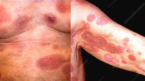What Is Mycosis Fungoides Symptoms Causes Treatment Diagnosis