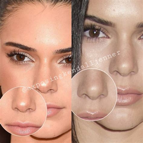Kendalljennerplasticsurgeries On Twitter Kendall Jenner Nose Scar