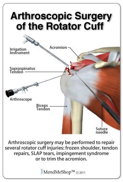 Arthroscopic Surgery For A Supraspinatus Tendon Rotator Cuff Tear