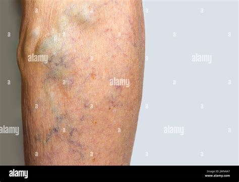 Varicose Veins Leg Hi Res Stock Photography And Images Alamy