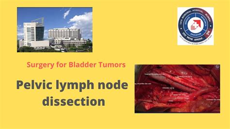 Pelvic Lymph Node Dissection Plnd Youtube