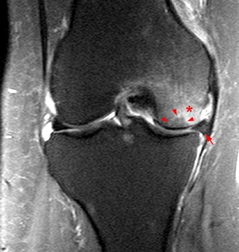 Subchondral Fracture Femoral Head