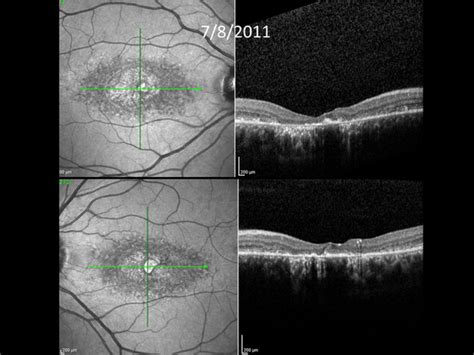 Stargardt Disease Oct The Retina Reference