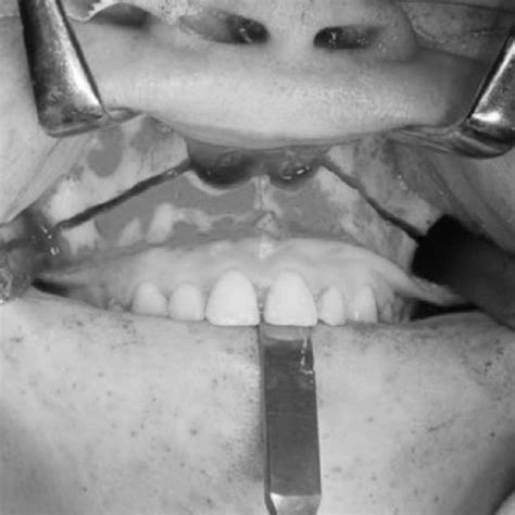 Representation Of A Hard And Soft Palate Incision Maxillary Division