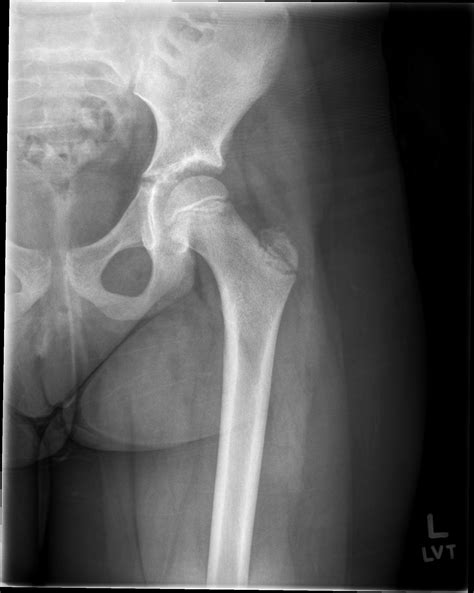 normal hip radiographs pediatric image