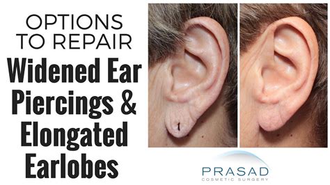 How Widened Ear Hole Piercings Can Be Repaired With Stitching Or Minor
