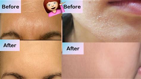 How To Get Rid From Oily And Dry Skin Instantly Home Remedies Youtube