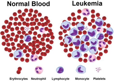 Normal And Leukemia Cells Download Scientific Diagram