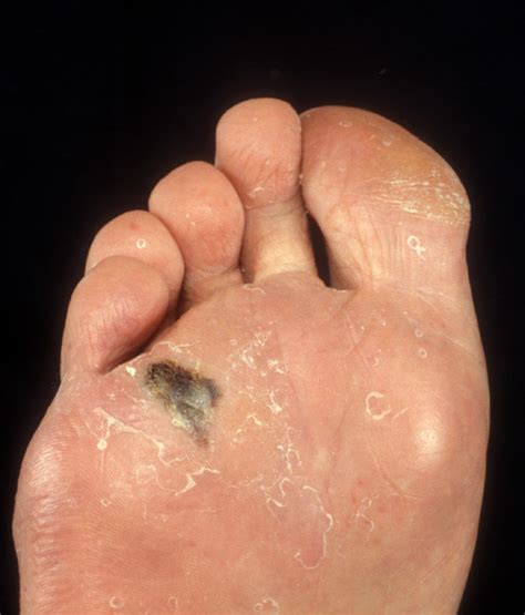 Toenail discoloration can be a local problem—just something wrong with the toenail for a short period of time. What are the Different Types of Malignant Melanoma ...