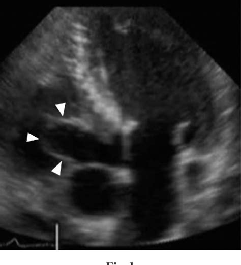 Figure 1 From Surgical Treatment For The Annulo Aortic Ectasia
