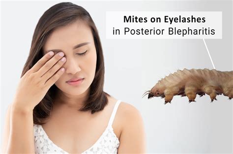 Mites On Eyelashes In Posterior Blepharitis Ungex