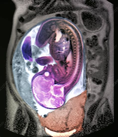 Placenta Previa Mri Scan Stock Image C0071990 Science Photo Library
