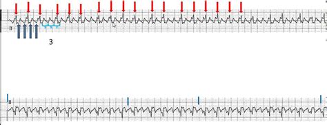 Atrial Flutter With Variable Conduction Youtube