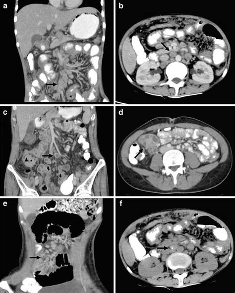 Role Of Ct And Mri In Abdominal Tuberculosis Springerlink