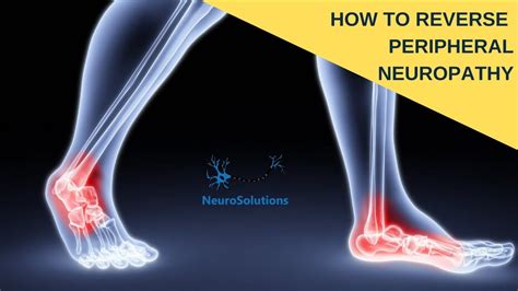How To Reverse Peripheral Neuropathy All About Diabetes