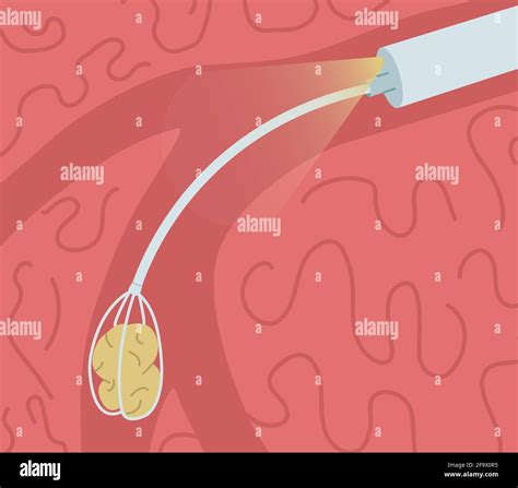 Removal Of A Stone From The Salivary Gland Duct Sialendoscopy Vector