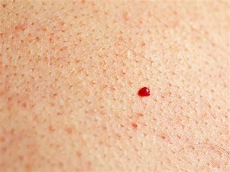 Skin Tag And Blemish Removal S3 Skin And Laser