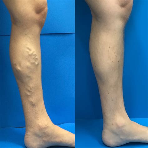 How To Recognize Varicose Veins Vein Specialists Of The Carolinas
