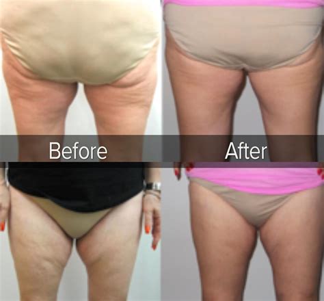 Post Weight Loss Skin Tightening New You Bariatric Center