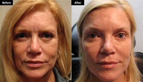 Liquid Face Lift Facelift Liquid Facelift Cosmetic Surgery