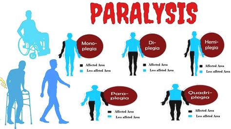 Paralysis Homeopathic Treatment Right Sided Paralysis Left Sided Paralysis