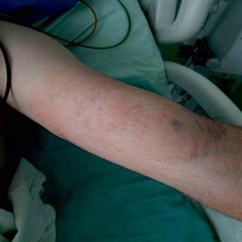 Hydrofluoric Acid Burn After Injection Of Calcium Gluconate Download