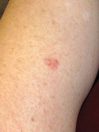 Dermatitis Rash On Arms
