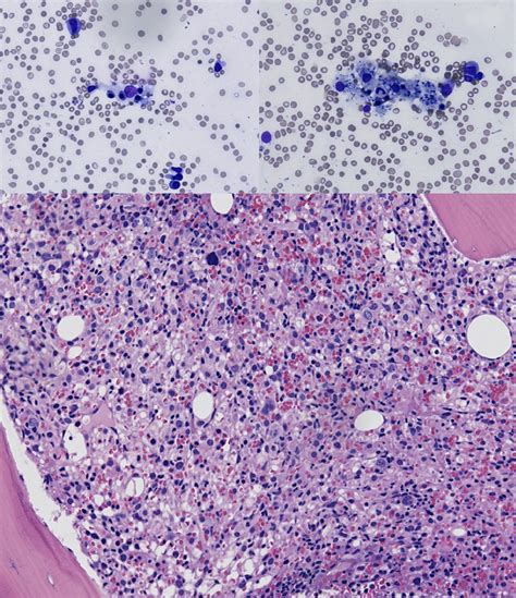 Adult Onset Hemophagocytic Lymphohistiocytosis Type 2 Presenting As A
