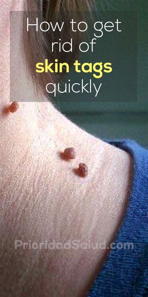 10 effective ways to get rid of skin tags naturally in 2020