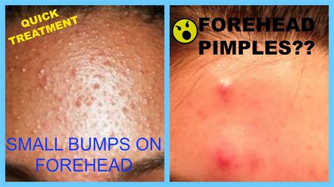 Also, discover their causes and how can you get rid of them with treatments and home remedies. How To Cure Pimples On Forehead at home using Natural ...
