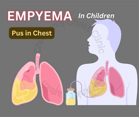 Empyema Or Pus In The Pleural Space In Children Dr Ankit Parakh