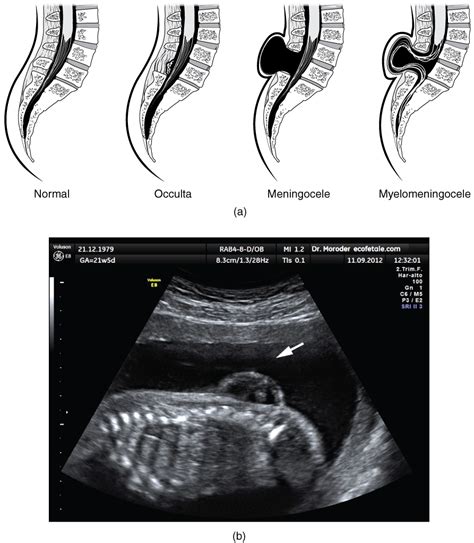 This Figure Shows The Spinal Cord In Spina Bifida A Birth Defect In