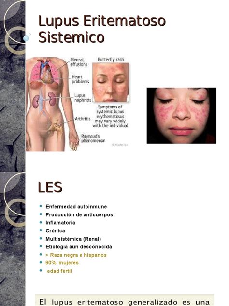 Lupus Eritematoso Sistemico Lupus Eritematoso Sistémico Inmunología