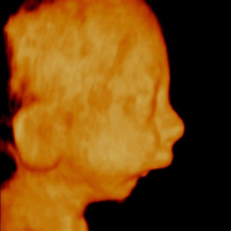 Three Dimensional Ultrasound Of The Cleft Soft Palate Arrows At 29