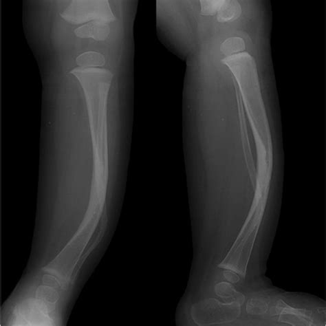 Anteroposterior And Lateral Radiographs Depicting An Anterolaterally